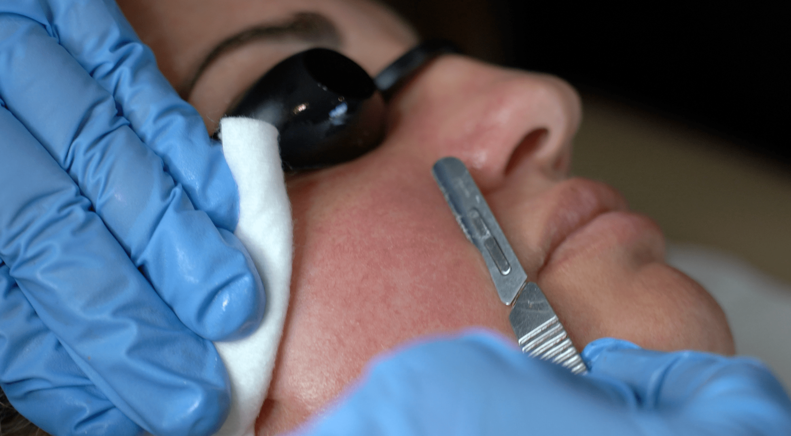Dermaplaning — exfoliation et peau lisse