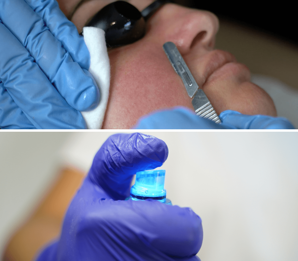 Hydraskin et Dermaplaning — les deux techniques Skin Glow
