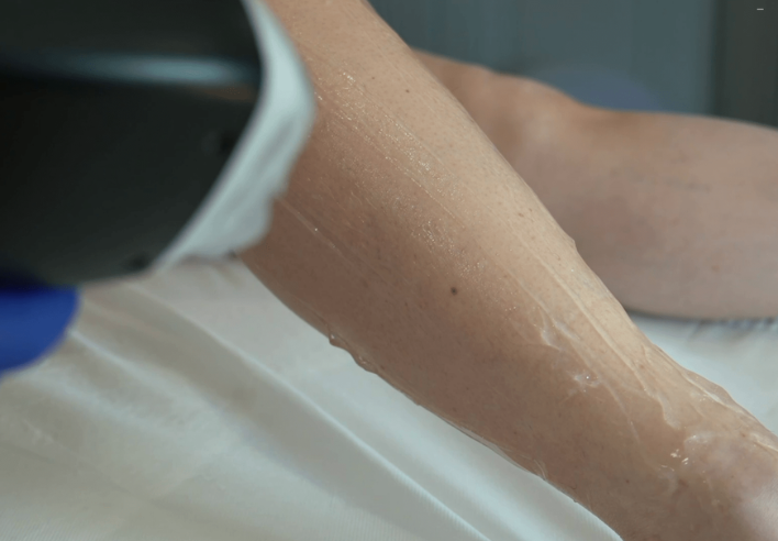Séance d'épilation au laser diode sur jambe — formation Elya Academy